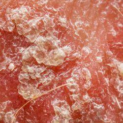 psoriasis